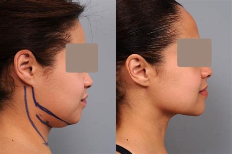 LIPOSUCTION .